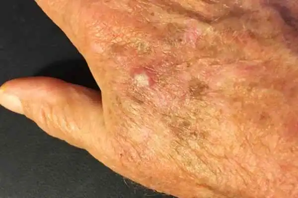 Cryopen For Actinic Keratoses 1 Image of Actinic keratoses Wakefield on a person hand